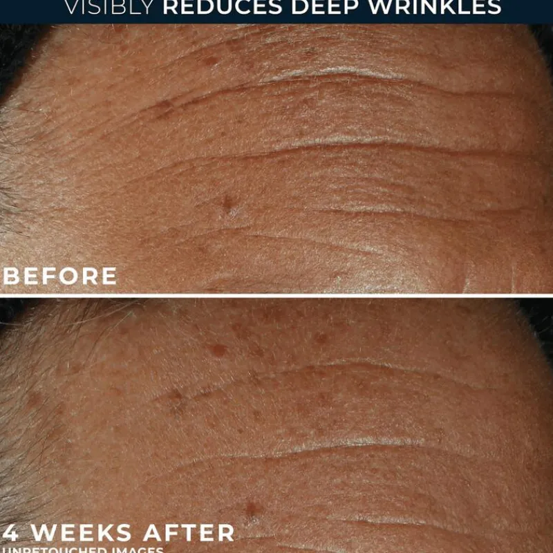 Best RoC Derm Correxion Fill + Treat Serum 15 ML